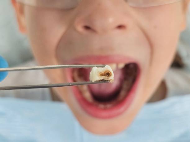 Best Emergency Dentist for Lost Fillings or Crowns in Mulino, OR